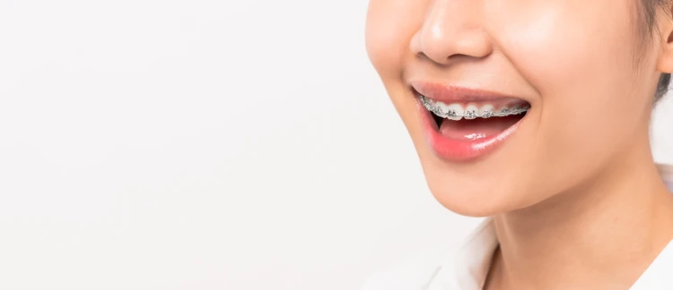 Pasang Behel Sapphire Premium di Klinik Gigi drg. Mia