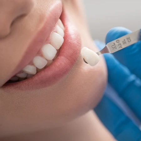 Direct Veneer Komposit Amaris Germany di Klinik Gigi Cheer Up