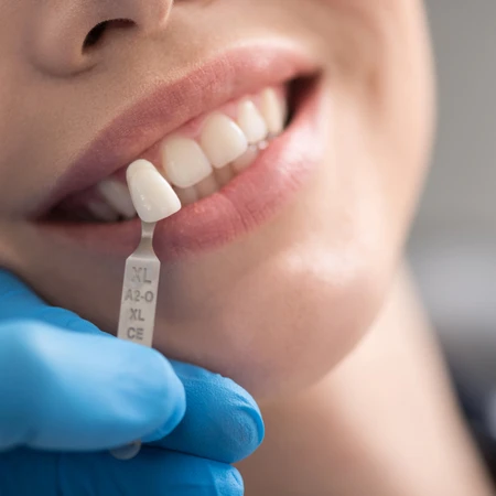 Crown Porcelain Fused to Metal (PFM) di Klinik Gigi Cheer Up