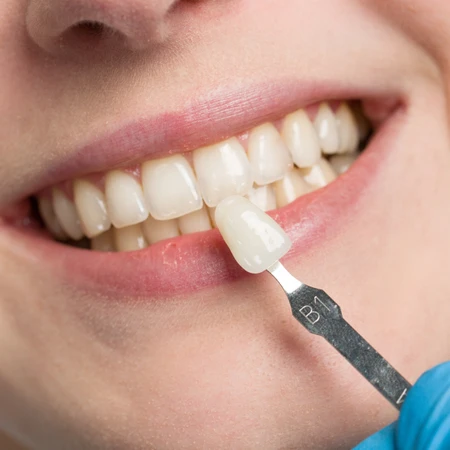 Indirect Veneer Keramik E-max di Klinik Gigi Cheer Up