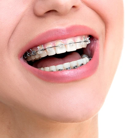 Pemasangan Behel Self Ligating Clear Damon + Rontgen Gigi di Parahita Lab di Klinik Gigi Cheer Up