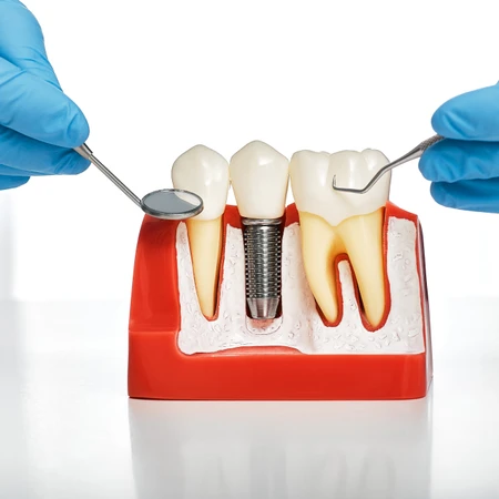 Implan Gigi Paket Premium di Klinik Gigi Cheer Up