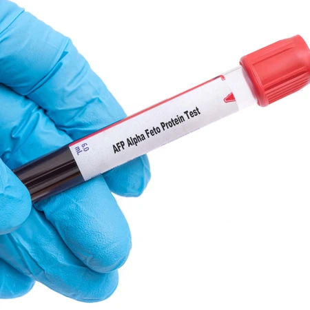 Pemeriksaan Kanker (AFP) di Amalia Medical Center