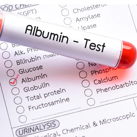 Pemeriksaan Hati (Albumin) di Amalia Medical Center