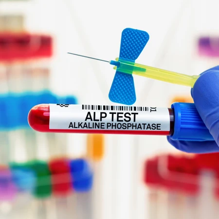 Pemeriksaan Hati (Alkali Fosfatase) di Amalia Medical Center