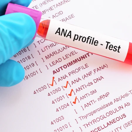 Pemeriksaan ANA PANEL TEST di Amalia Medical Center