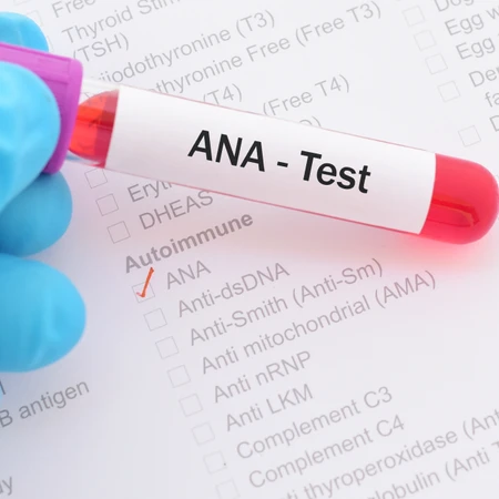 Pemeriksaan ANA Test di Amalia Medical Center