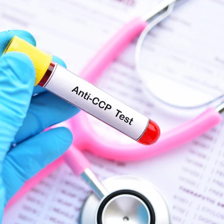 Pemeriksaan Anti CCP di Amalia Medical Center