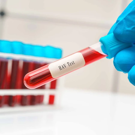 Pemeriksaan Hati (Anti HAV) di Amalia Medical Center