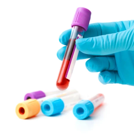 Pemeriksaan Anti B2 - Glycoprotein (B2-GP1) IgM di Amalia Medical Center