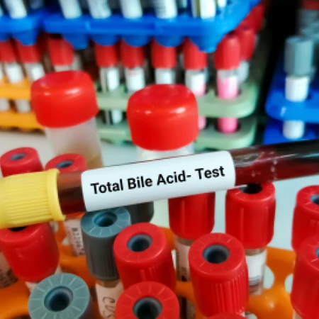 Pemeriksaan Hati (Bile Acid) di Amalia Medical Center