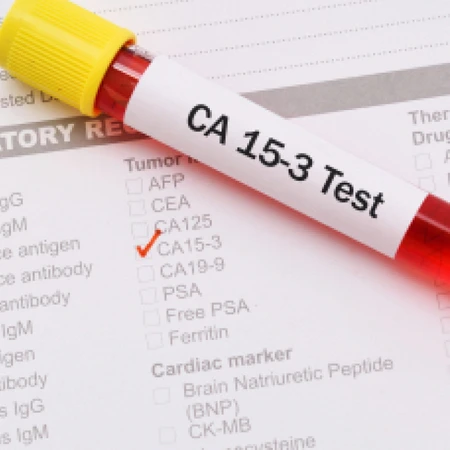 Pemeriksaan Kanker (CA 15-3) di Amalia Medical Center