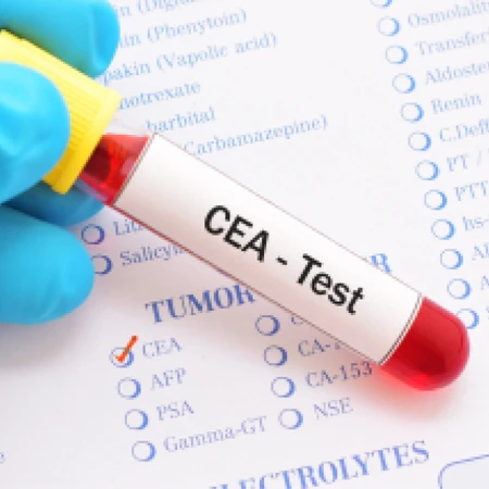 Pemeriksaan Kanker (CEA) di Amalia Medical Center