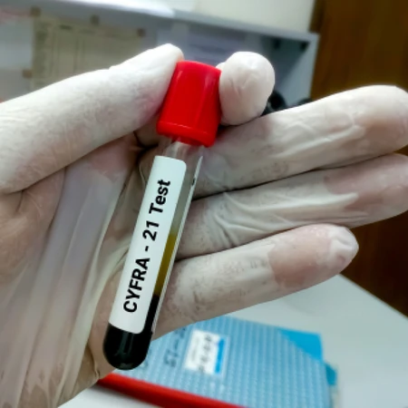 Pemeriksaan Kanker Paru-paru dengan Tes Cyfra 21-1 di Amalia Medical Center