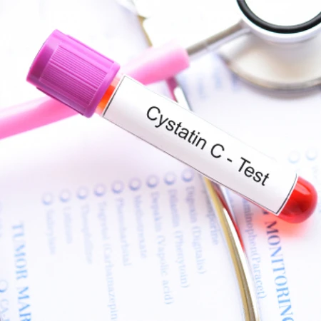 Pemeriksaan Cystatine C di Amalia Medical Center
