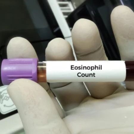 Pemeriksaan Eosinophil di Amalia Medical Center