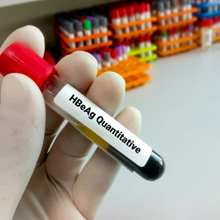 Pemeriksaan Hati (Hbe Ag) di Amalia Medical Center