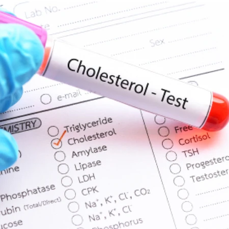 Pemeriksaan Kolesterol (HDL) di Amalia Medical Center