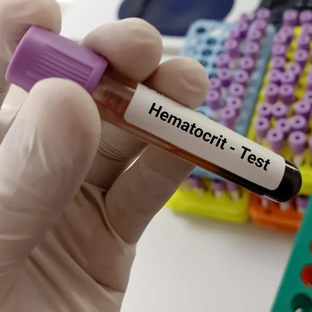 Pemeriksaan Hematokrit di Amalia Medical Center