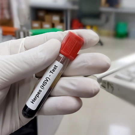 Pemeriksaan IgG HSV 1 di Amalia Medical Center