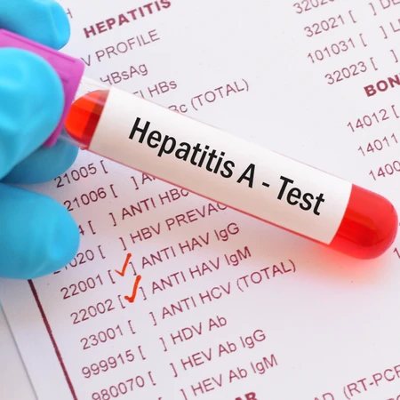 Pemeriksaan Hati (IgM Anti HAV) di Amalia Medical Center