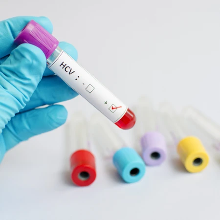 Pemeriksaan Hati (IgM Anti HCV) di Amalia Medical Center