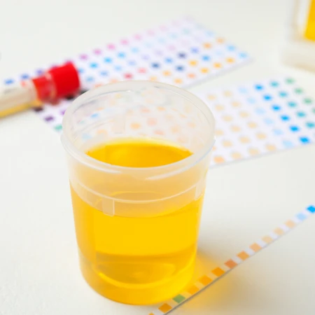 Pemeriksaan Kultur Urine (Vitek Method) untuk Skrining Infeksi Saluran Kemih di Amalia Medical Center