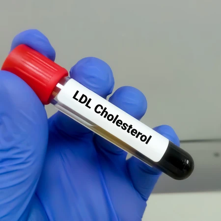 Pemeriksaan Kolesterol (LDL Direct) di Amalia Medical Center