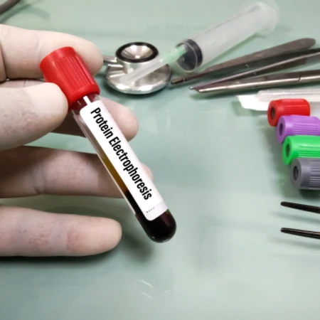 Pemeriksaan Protein Elektrophoresis (ELP) di Amalia Medical Center