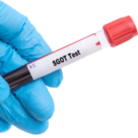 Pemeriksaan Hati (SGOT) di Amalia Medical Center