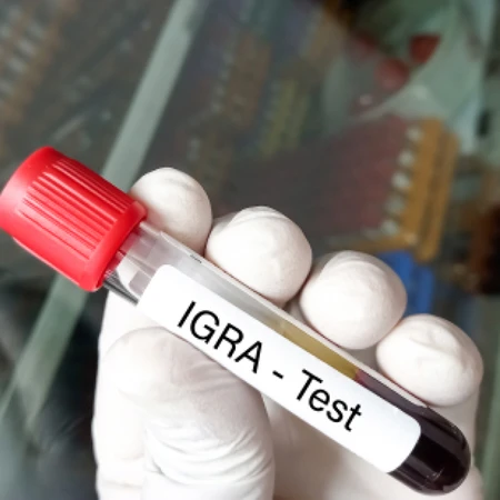 Pemeriksaan Paru-paru (TB-IGRA) di Amalia Medical Center