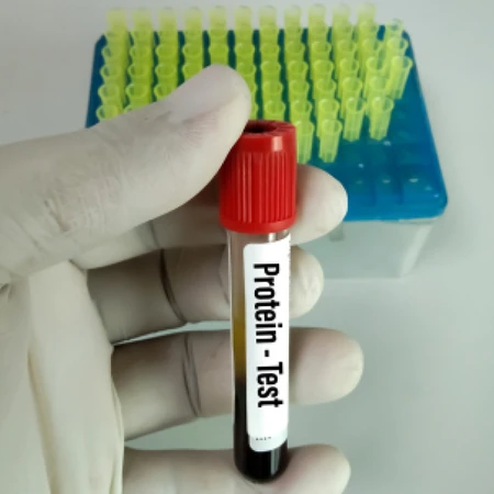 Pemeriksaan Total Protein di Amalia Medical Center