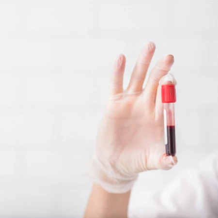 Pemeriksaan TSH Receptor Antibodies ( TRAB ) di Amalia Medical Center