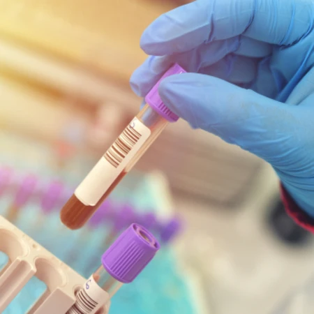 Pemeriksaan Viscositas Darah di Amalia Medical Center