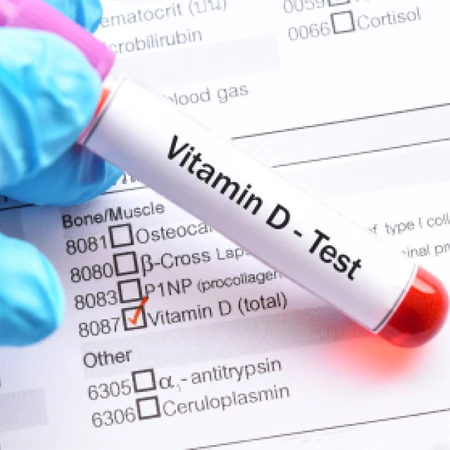 Pemeriksaan Vitamin D di Amalia Medical Center