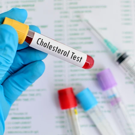 Pemeriksaan Kolesterol Total di Amalia Medical Center