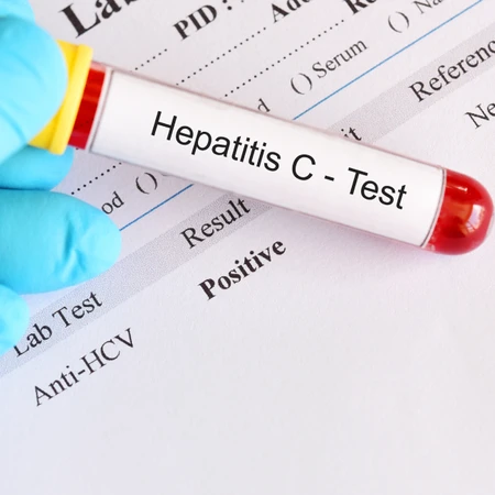Pemeriksaan Hepatitis (Anti HCV) di Amalia Medical Center