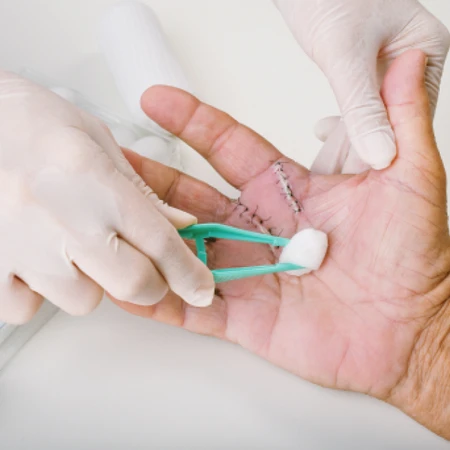 Angkat Jahitan 7 - 13 di FastMed