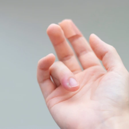 Insisi Abses Kecil di FastMed