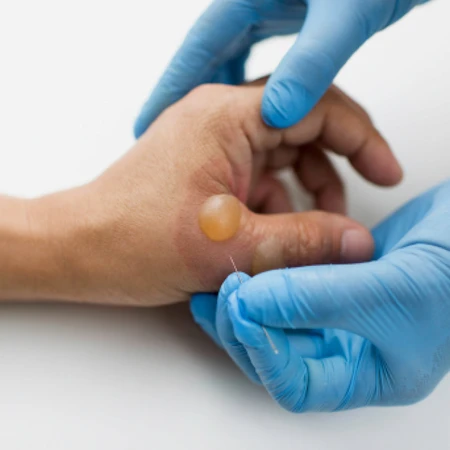 Insisi Abses Besar di FastMed