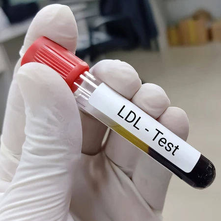Pemeriksaan Kolesterol (LDL) di FastMed