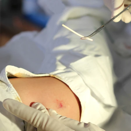 Jasa Lepas IUD di Klinik Surya Medika