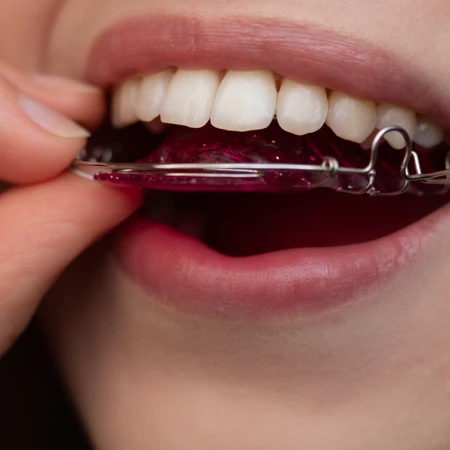 Hawley Retainer (Rahang atas dan rahang bawah) di Klinik Surya Medika