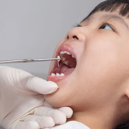 Cabut Gigi Anak (AL) di Klinik Surya Medika