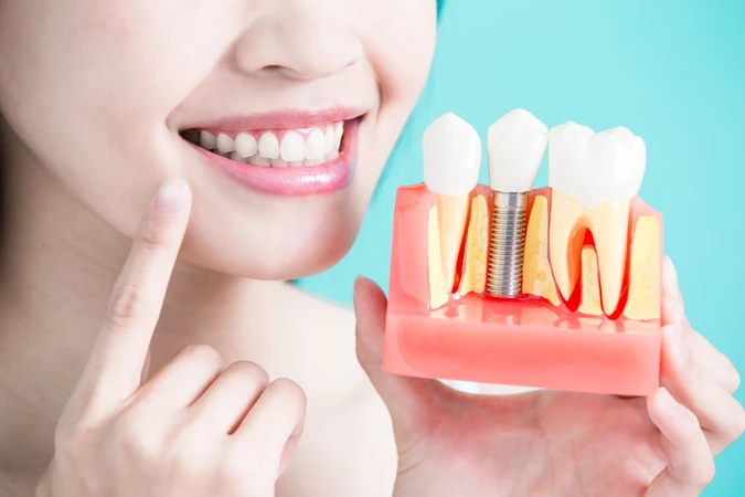 Implan Gigi + Crown Zirconia di Mydentismile