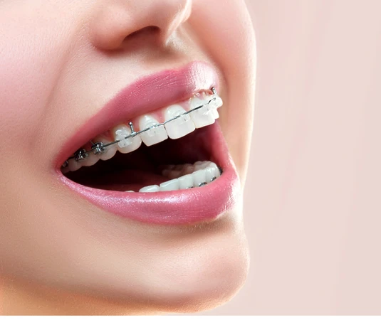 Pasang Behel Sapphire drg. Spesialis Ortodontik di Estetika Dental Clinic