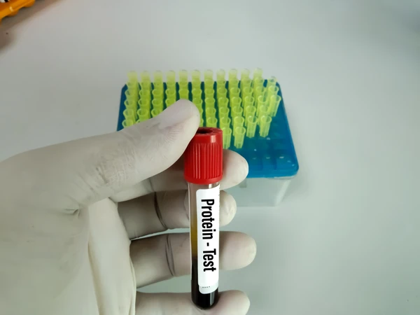 Pemeriksaan Protein Total di Klinik Ammyn Sukabumi