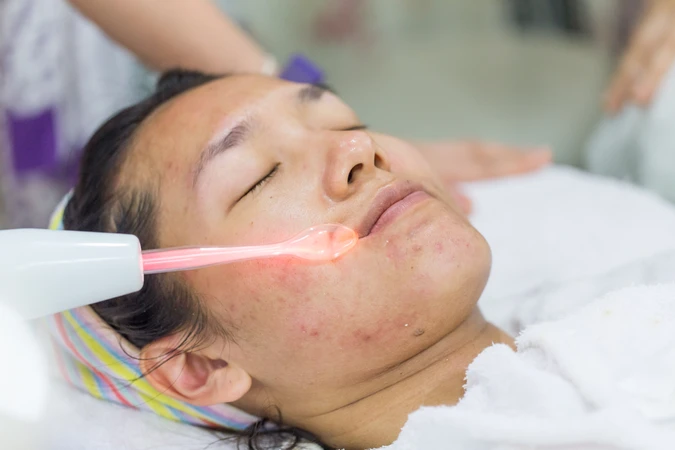 IPL Upper Lip di Nadisa Beauty Care