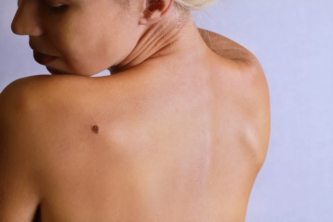 Cauter Milia/Kutil/Keratosis (1-10 titik) di Klinik Ozthetique Jakarta
