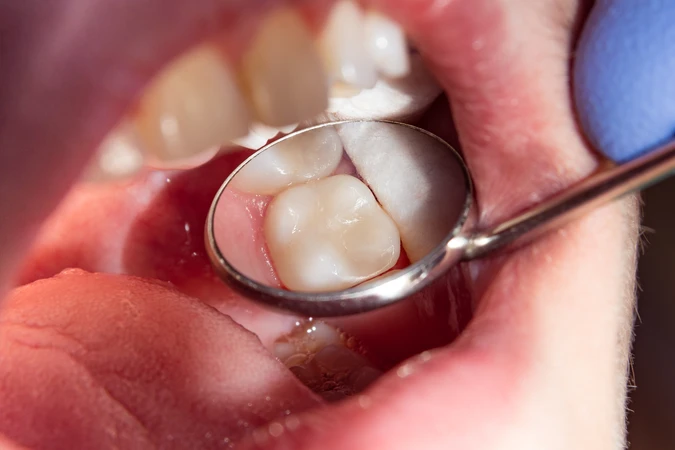 Penambalan GIC Gigi Sulung di Kalibata Dental Center